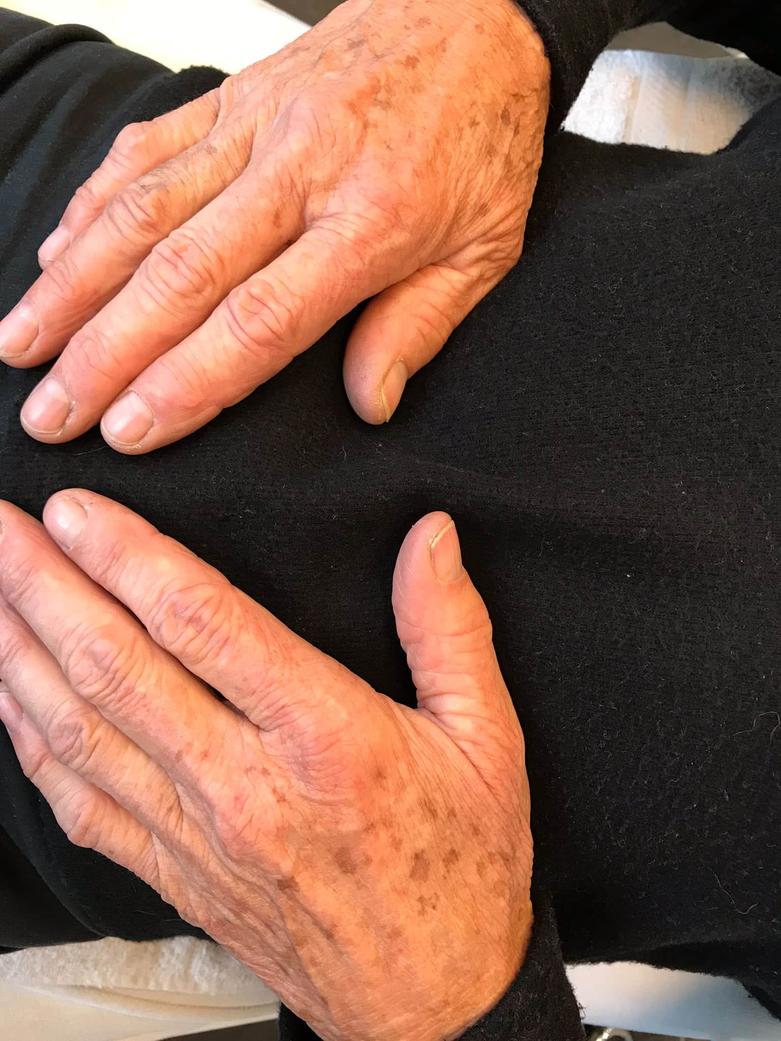 Pigmentvlekken voor de behandeling